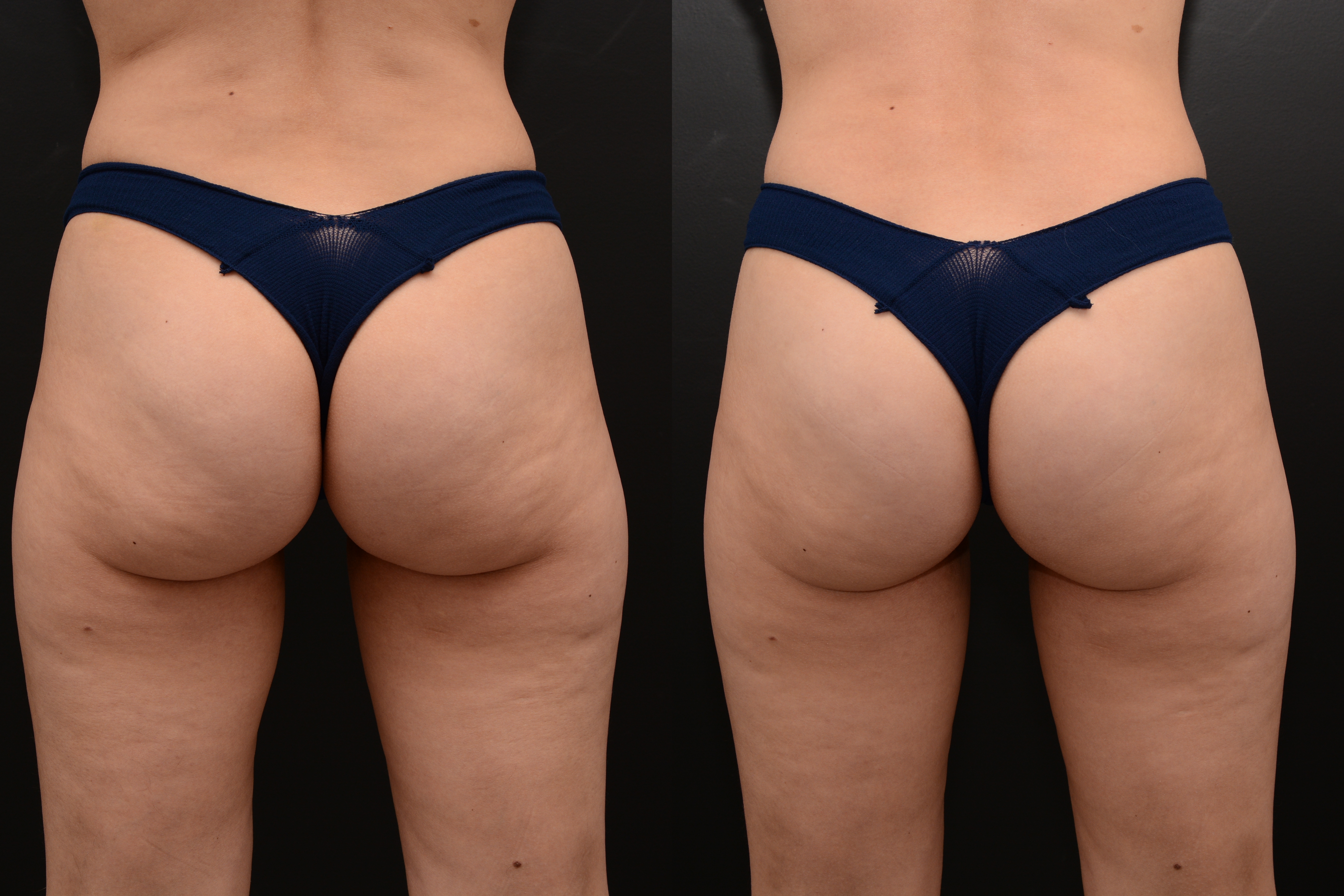 Emsculpt buttocks enhancement after 4 treatments - before and after